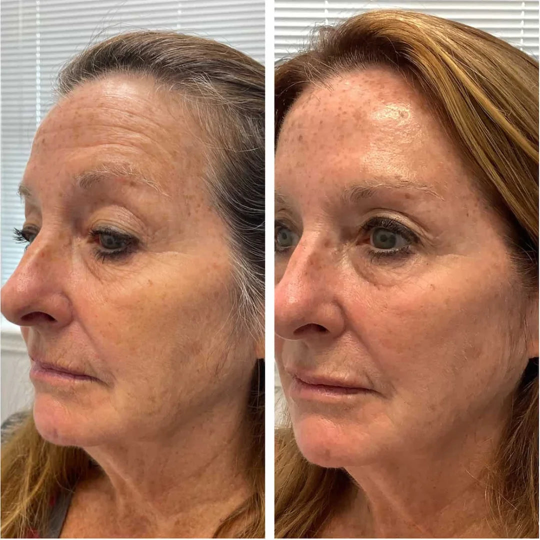 Antes e depois do uso da máscara