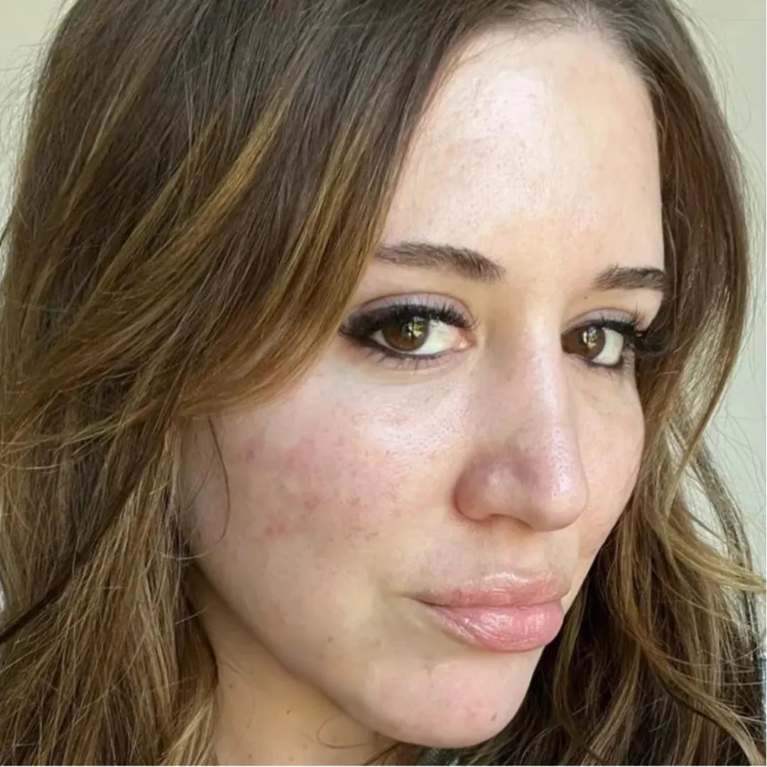 Pele com acne e vermelhidão antes do tratamento